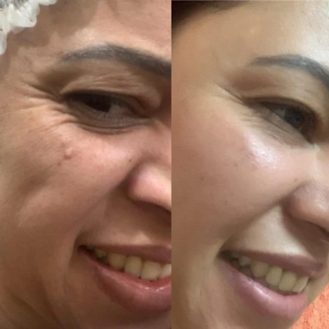 Antes e depois — resultado real do Protocolo Micropeeling