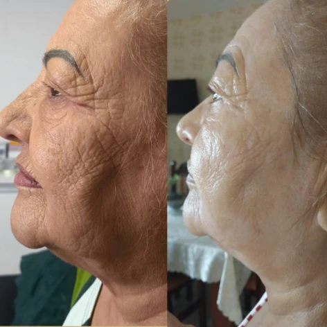 Antes e depois — resultado real do Protocolo Micropeeling