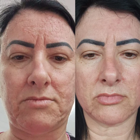 Antes e depois — resultado real do Protocolo Micropeeling