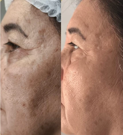 Antes e depois — resultado real do Protocolo Micropeeling